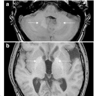 Different dynamics of Gd accumulation in dentate nucleus (DN) (a) and ...