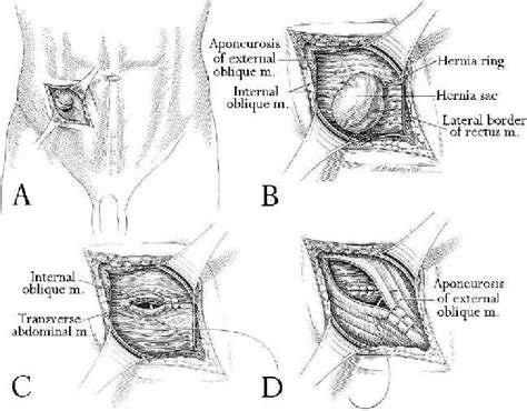 Spigelian Hernia: Surgical Anatomy, Embryology, and Technique of Repair ...