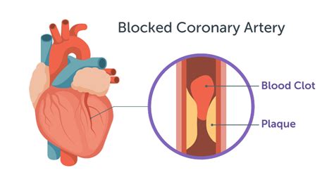 Heart Disease | MemorialCare