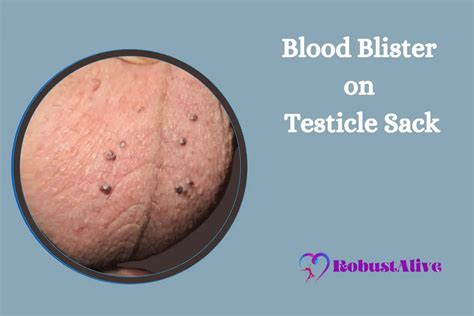 Blood Blister on Testicle Sack - Causes, Symptoms, and Treatment