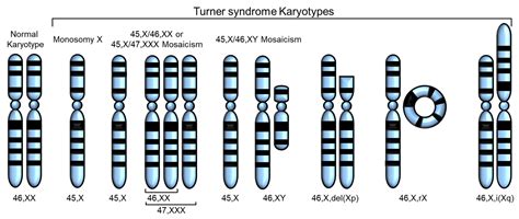 Turner Syndrome Male Karyotype