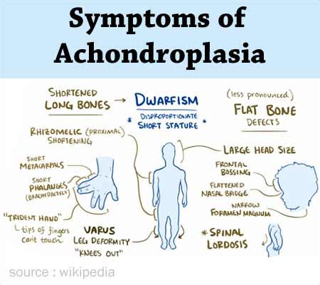 Hypopituitary Dwarfism Vs Achondroplasia