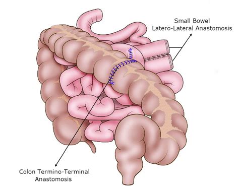 Perforated Viscus: What Is It, Causes, Symptoms, And More, 44% OFF