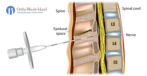 Procedure for Lumbar Epidural Steroid Injection: Steps and Precautions ...