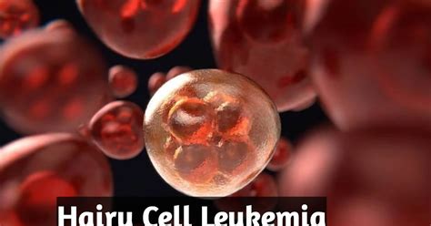 Hairy Cell Leukemia, Symptoms And Life Expectancy