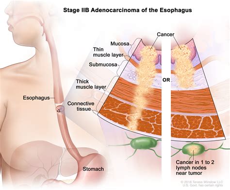 Esophageal Cancer | Vanderbilt-Ingram Cancer Center