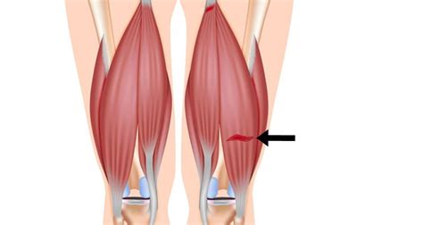 Hamstring Strain - Causes, Treatment & Exercises - Sportsinjuryclinic.net