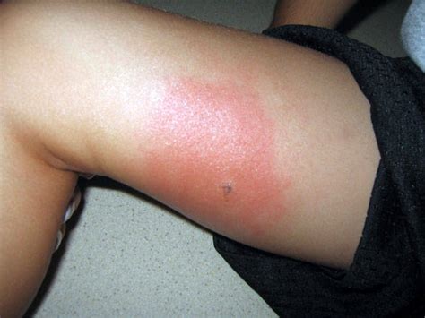 Hindustanlink.com: Health Care Blog » Symptoms Of Mosquito and Insect Bite