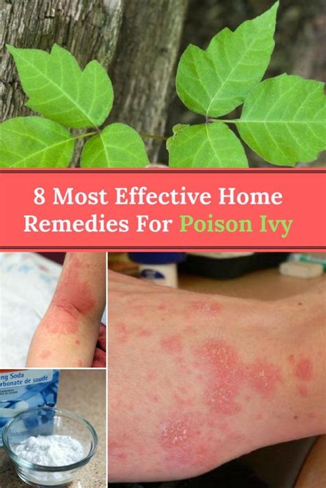 Poison Ivy Home Remedies: 8 Most Effective Remedies For Poison Ivy ...