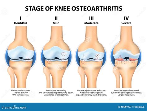 Stages Of Knee Osteoarthritis (OA). Stock Vector - Image: 45644007