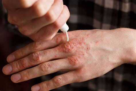 How to Prevent Psoriasis Flare-Ups: Managing the Autoimmune Disease