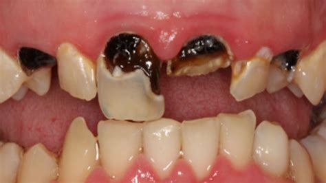 How to know if you are prone to cavities? - Authority Dental Blog