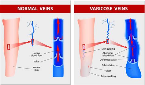 Understanding Varicose Veins: Causes, Symptoms, and Treatments