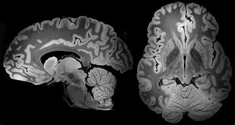 MRI captures the most detailed view yet of a whole human brain ...