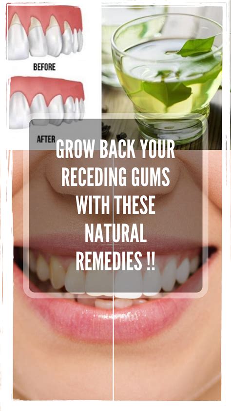 GROW BACK YOUR RECEDING GUMS WITH THESE NATURAL REMEDIES !! | Receding ...