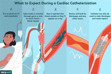 What to expect during Cardiac Catheterization - THW Cardiology Center ...