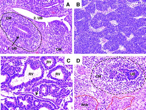 Histology of Wilms tumour. Cross section (1. UB) and longitudinal ...