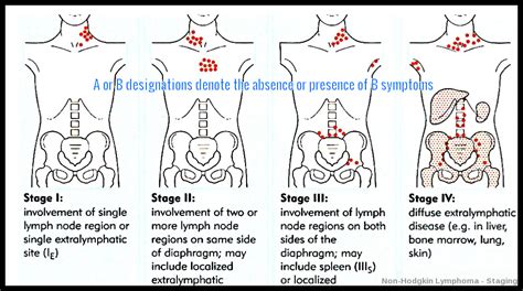 non-Hodgkin's lymphoma - Rena Gaither