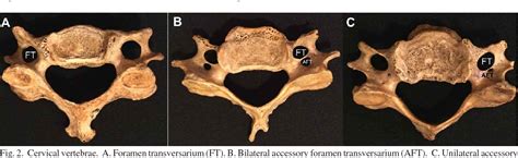 Transverse Foramen Of Cervical Vertebrae