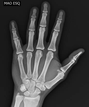 Thumb Proximal Phalanx Fracture