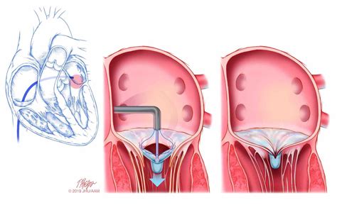 Mitral Regurgitation: A “Leaky Valve” - Gregory Koshkarian, MD, FACC