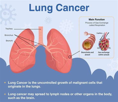 Overview of Lung Cancer: Signs, Symptoms, Diagnosis & Treatment