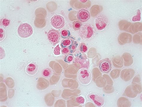 fogyasztás ének Férfi refractory anemia with ringed sideroblasts dátum ...