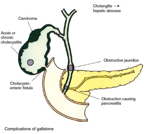 Biliary Infections and Complications | RECAPEM