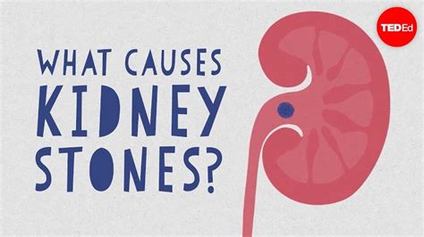 What causes kidney stones? | Health Blog - Read Health Advice on ...