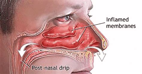 17 Home Remedies for Blocked Nose or Stuffy Nose - The Discover Reality