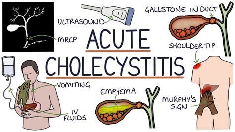 Understanding Acute Cholecystitis - YouTube