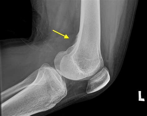 apa gambaran radiologi khas pada chondrosarcoma