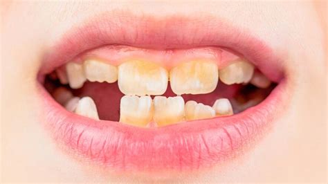 Teeth Stains And What They Mean | OnlyMyHealth