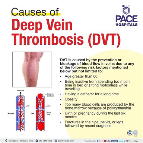 Deep Vein Thrombosis, DVT - Symptoms, Causes and Complications