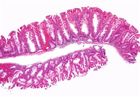 File:Sessile serrated adenoma 2 low mag.jpg - Wikimedia Commons