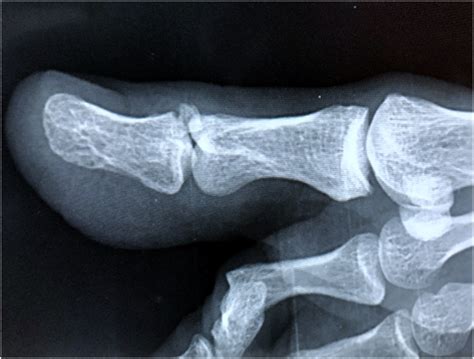 Great Toe Distal Phalanx Fracture