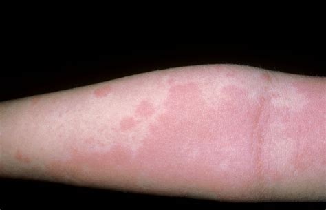 How Long Do Allergy Rashes Typically Persist?