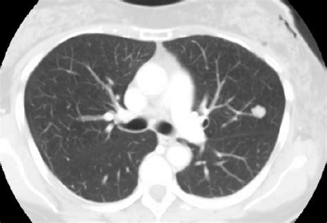 A classification of pulmonary nodules by CT scan - ecancer