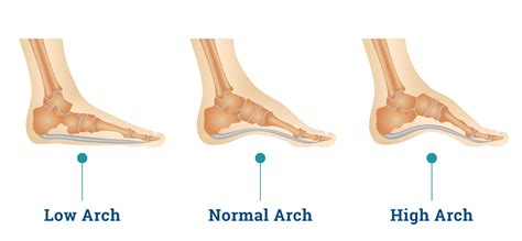 Know Your Arches - ShoeInsoles.co.uk