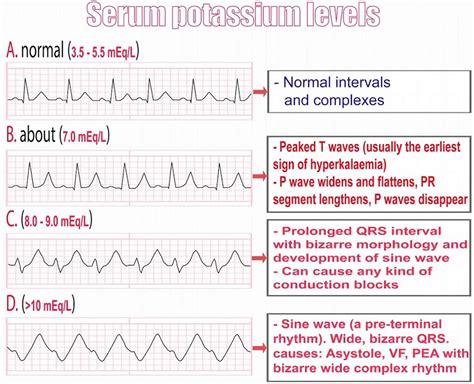 Ecg hyperkalemia | Hyperkalemia, High potassium symptoms, Fluid and ...