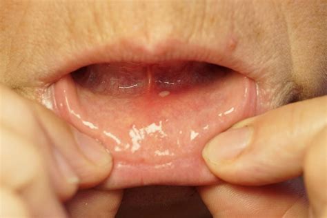 10 Primary Symptoms and Treatments of Dry Mouth Syndrome - Facty Health