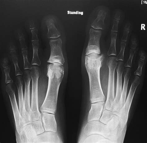 Big Toe Arthritis | Arthritis Treatment & Surgery | David Redfern