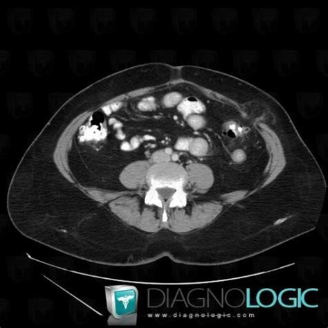 Radiology case : Spiegel hernia (CT) - Diagnologic