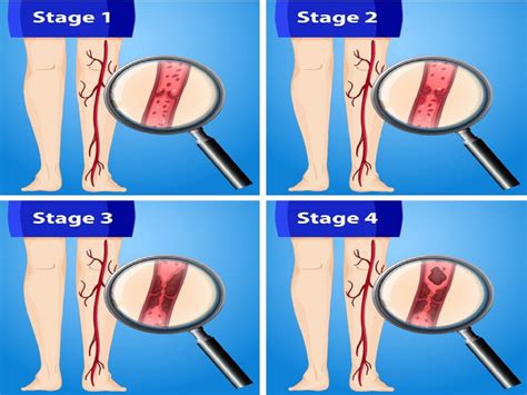 What is thrombosis? Types, Causes and Symptoms by mon blogs on Dribbble