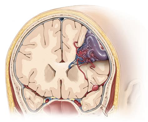 Arteriovenous Malformation: What the Patient Needs to Know | Aaron ...