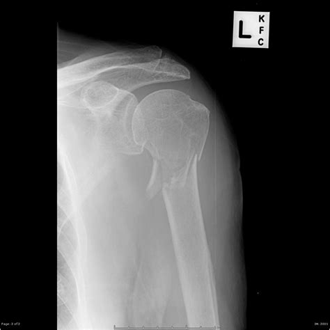 Humerus fracture - wikidoc