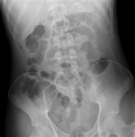 Intestinal Perforation- Pneumoperitoneum – Undergraduate Diagnostic ...