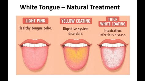 White Tongue - Natural Treatments & Causes