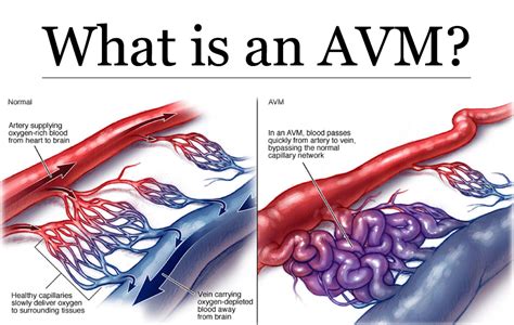 Arteriovenous Malformation - Brain Avm - Causes, Symptoms, Treatment