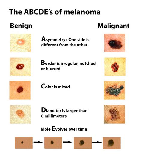 Door Dash: Melanoma In Children